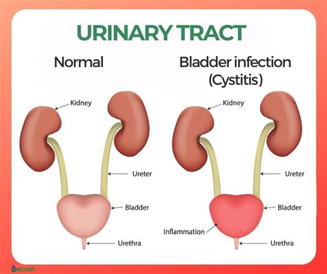 Bladder Inflammation (Cystitis): Causes, Symptoms, and 